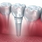implants dentaires
